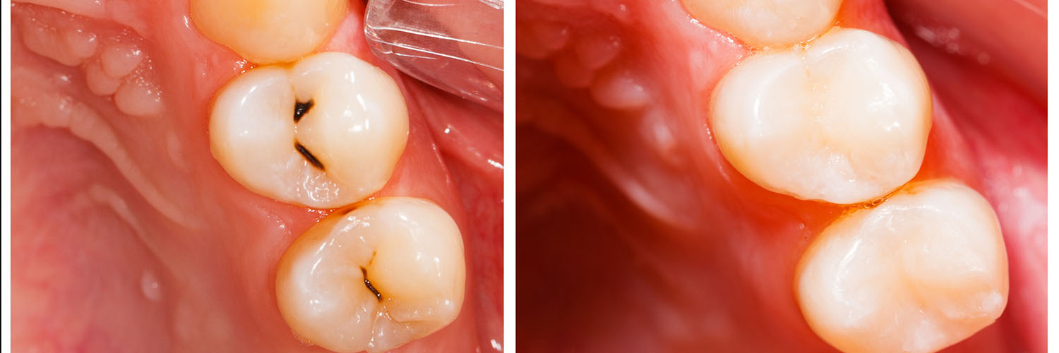 Smiles Dental at Reston Town Center | Dental Fillings, Extractions and Dental Cleanings