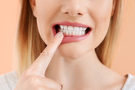 Smiles Dental at Reston Town Center | Dental Fillings, Dental Sealants and Inlays  amp  Onlays